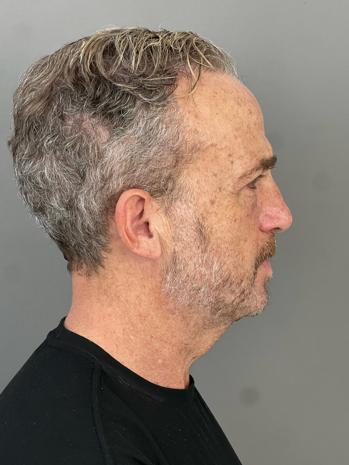 Male Upper & Lower Blepharoplasty in His 60s, after, view 3