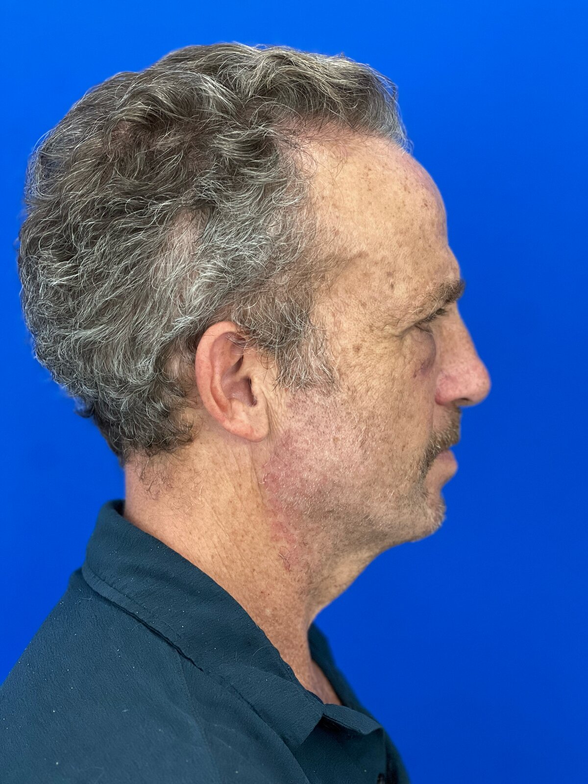 Male Upper & Lower Blepharoplasty in His 60s, before, view 3